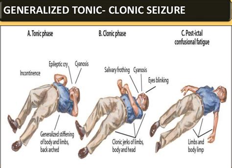 tonic definition seizure