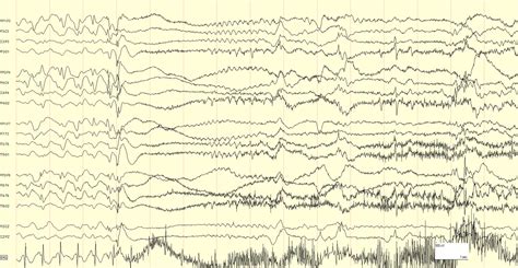 tonic seizure eeg