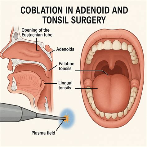 Understanding Tonsil and Adenoid Surgery: What You Need to Know About Relief and Recovery
