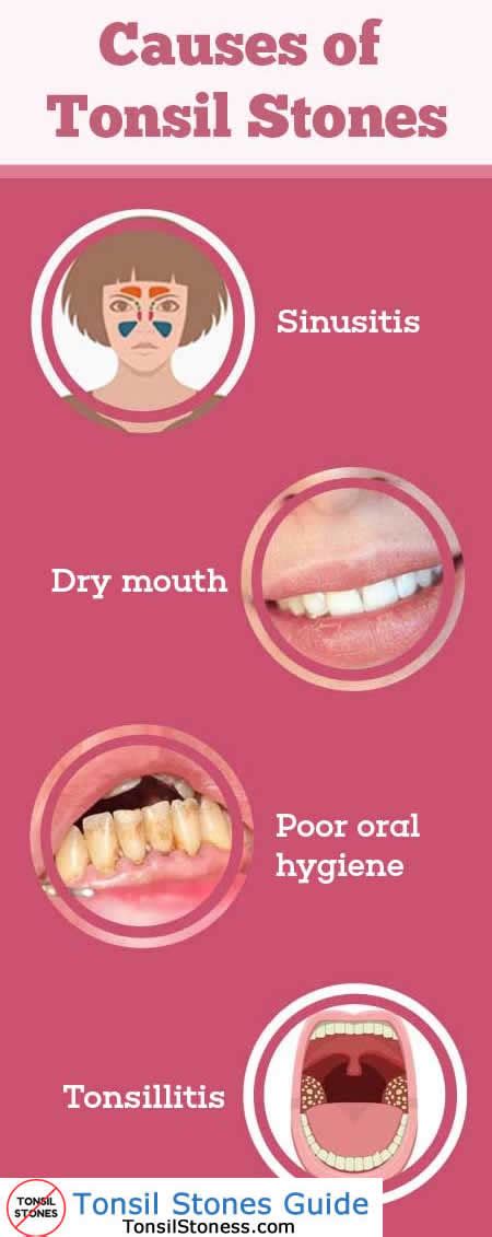 tonsil stones caused by allergies