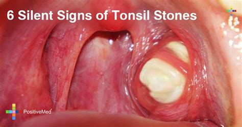 tonsil stones contagious