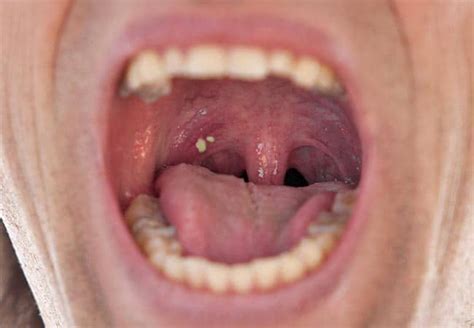 tonsil stones feel like something in throat