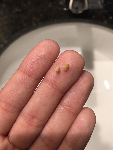 tonsil stones pictures coughed up