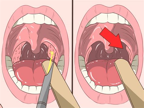 Effective Tonsil Stones Removal: Say Goodbye to Bad Breath