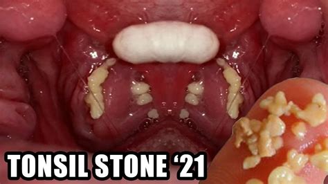 tonsil stones smell horrible