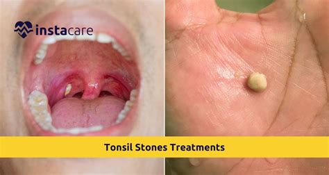 Breathe Easy Again: The Power of Tonsil Stones Supportive Therapy Revealed