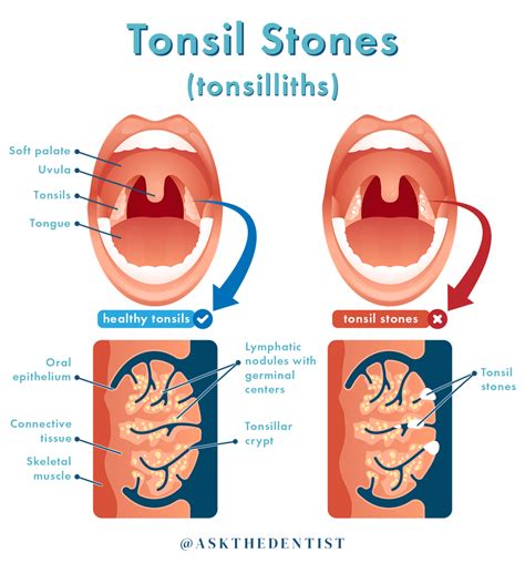 tonsil stones symptoms nhs