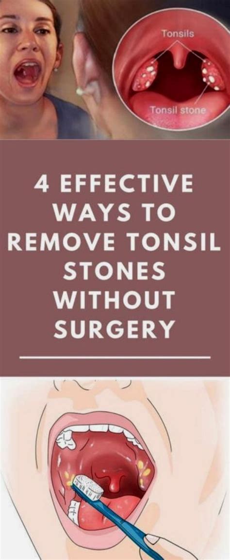tonsil stones treatment cost