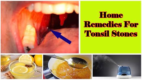 tonsil stones treatments at home