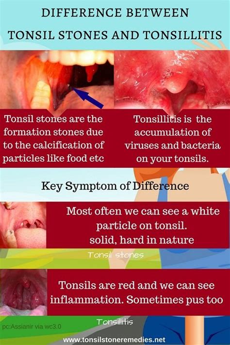 tonsil stones vs tonsillitis reddit