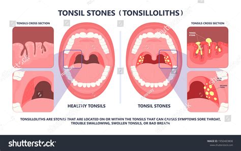 Tonsil Stones With Strep