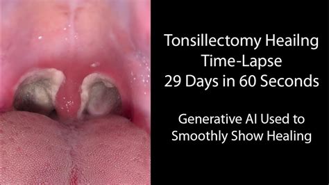 Recovering from Tonsil Surgery: What to Expect During Tonsil Surgery Recovery