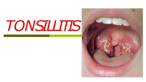 Tonsilitis