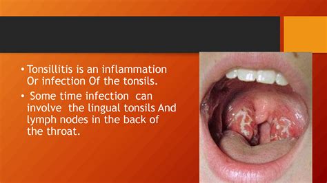 tonsillitis icd 10 guidelines
