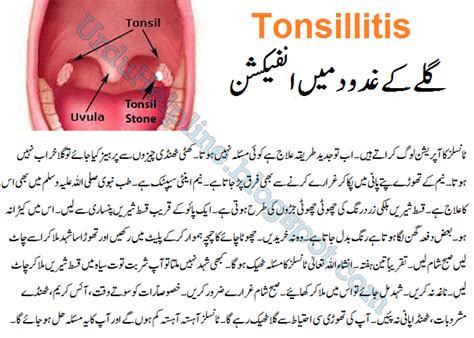 tonsillitis meaning in urdu