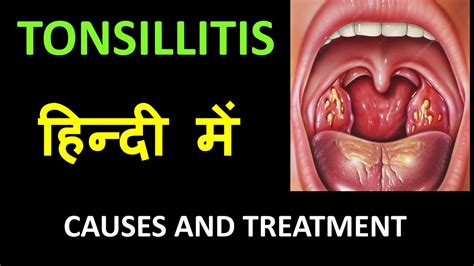 tonsils meaning in hindi