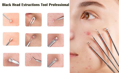 Tools For Acne Extraction