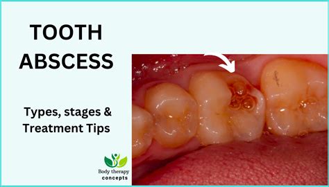 Tooth Abscess For Years Reddit