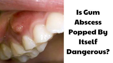 Tooth Abscess Keeps Popping