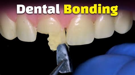 Tooth Bonding Youtube
