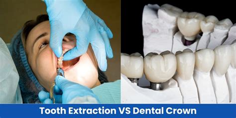 Tooth Crown Or Extraction