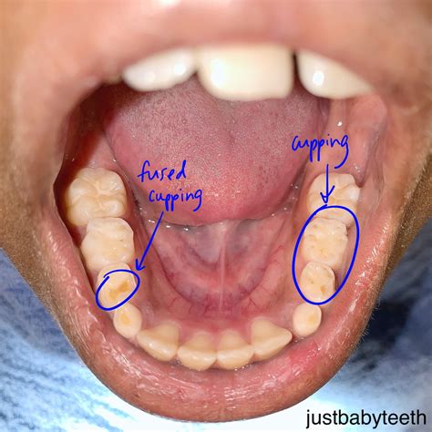 tooth cupping vs cavity