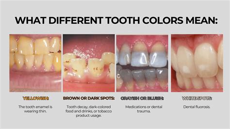 tooth discoloration