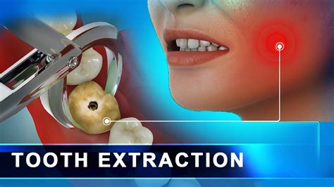Tooth Extraction And Dizziness