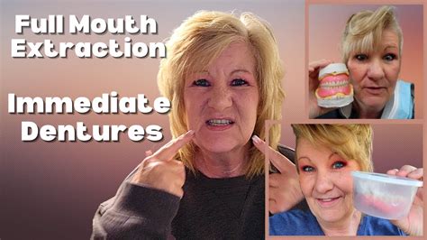 Tooth Extraction And Immediate Dentures
