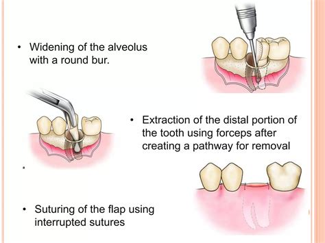 Tooth Extraction And Sutures