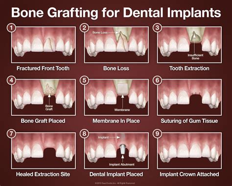 Tooth Extraction Bone Graft Rejection