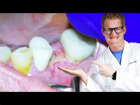 Tooth Extraction Bone Visible