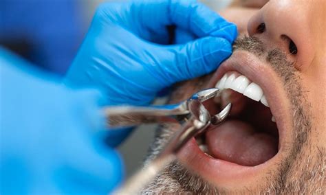 Tooth Extraction For Bridge