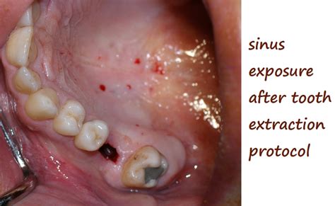 Tooth Extraction Sinus Exposure