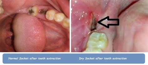 Tooth Extraction Socket Pictures