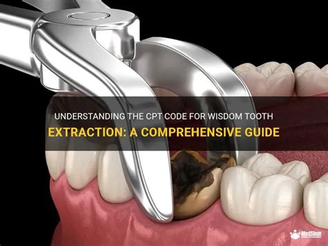 Tooth Extraction Surgery Cpt Code