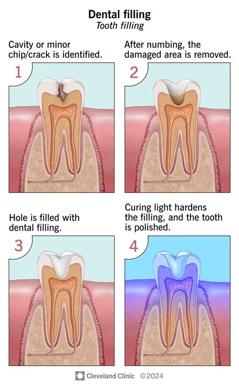 Tooth Filling Too Smooth