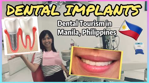tooth implant price philippines 2024