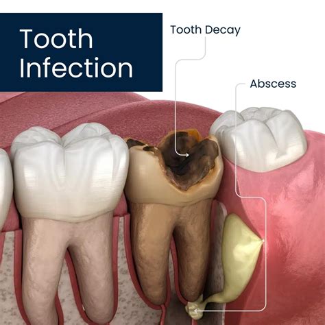 tooth infections