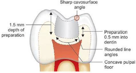 Tooth preparation