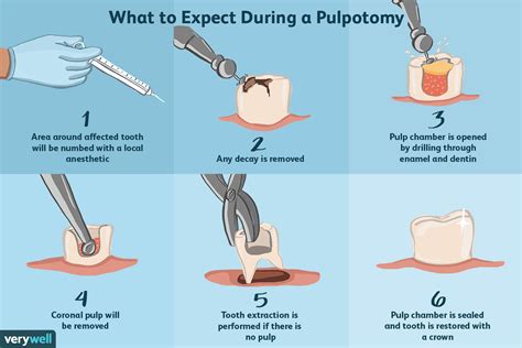 Tooth Pulpotomy Procedure