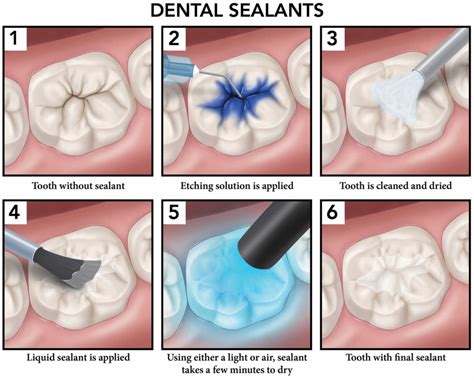 Tooth Sealant Procedure