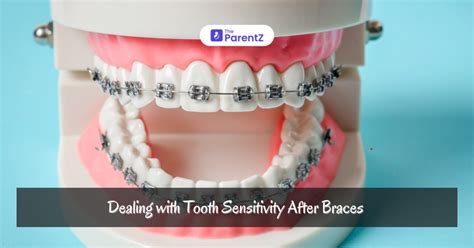 Tooth Sensitivity After Braces Removed