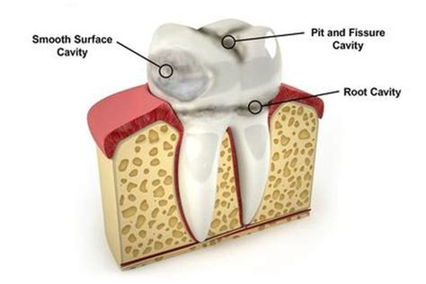 Tooth Smooth Surface Cavity