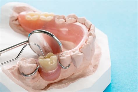 Tooth Supported Removable Partial Denture
