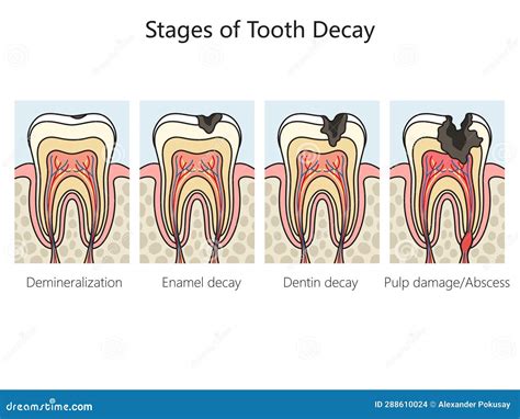 Tooth Decay Diagram