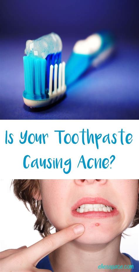 Toothpaste Causing Lips To Peel