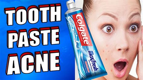 Toothpaste Help Zits Go Away
