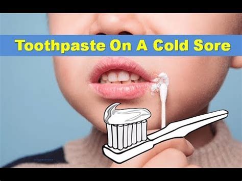 toothpaste on a cold sore remedy
