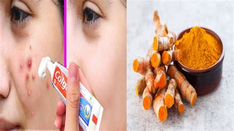 Toothpaste On Acne Scars